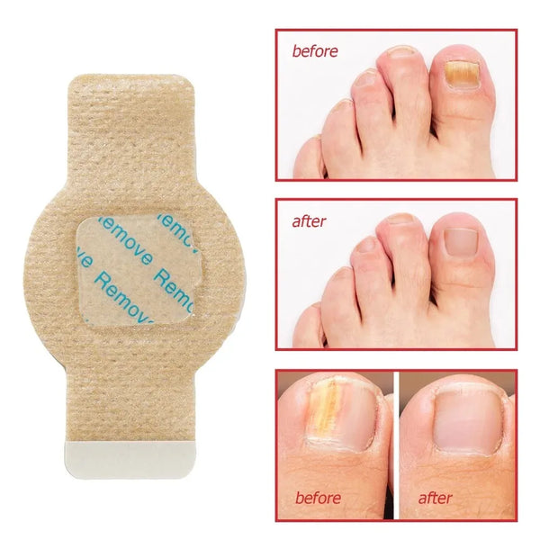 Nail-Fungus-Patch-Waterproof-Nail-Repair-Patch-Ingrown-Correction-Sticker-Damaged-Nail-Gray-Care-Patch-Feet.jpg
